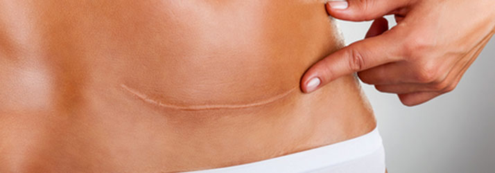 Spinal Decompression vs. Surgery: Non-Invasive Relief for Herniated Discs